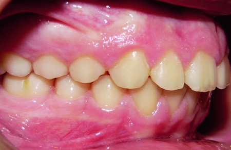 10B) revelaram que, após a distalização ativa e durante a fase subsequente de retração dos dentes anteriores e alinhamento final dos arcos dentários, não ocorre perda de ancoragem dos dentes