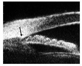 53 FIGURA 1 Imagem da UBM obtida às 6 horas, no escuro, mostrando um corte radial do ângulo irido-corneano identificando a localização do esporão escleral A seta demonstra a localização do esporão