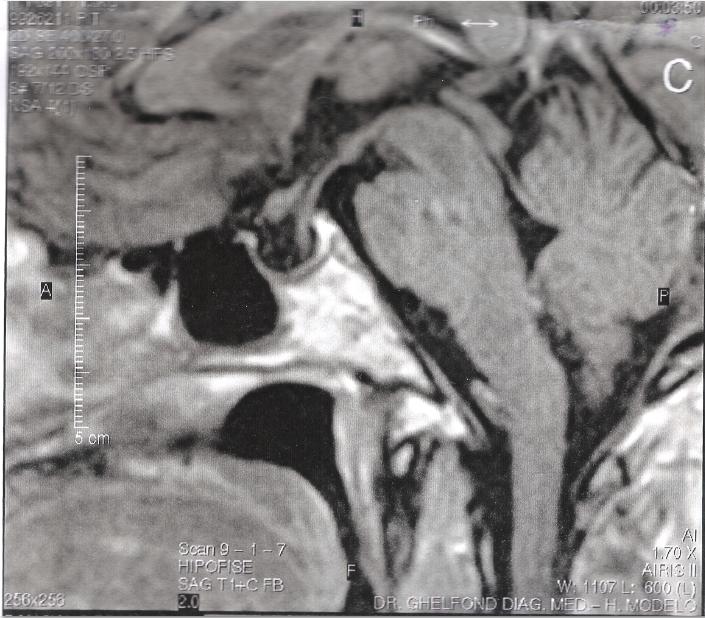 ANEXO Imagem de RNM da sela túrcica vazia da paciente do caso 1.