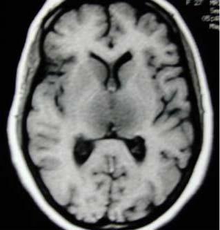 TOMOGRAFIA COMPUTADORIZADA Corte transversal do cérebro de um paciente com um tumor, obtido por um tomógrafo