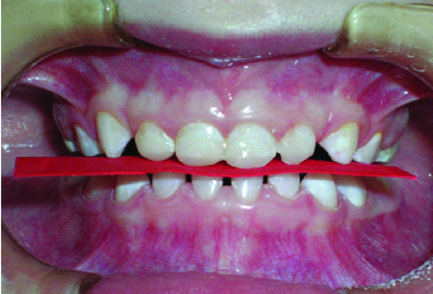 Figuras 1A) Paciente com oclusão em MIH, mostrando a relação de cruzamento dentário anterior; 1B-D) e em relação cêntrica, evidenciando a relação de topo dos dentes anteriores enquanto os posteriores