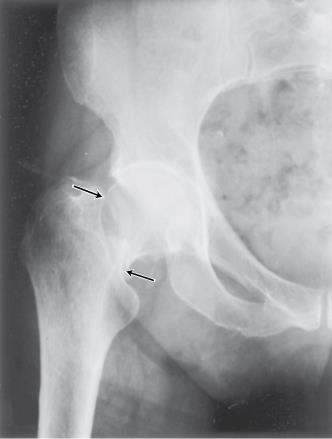 Exemplo Prótese da anca Com a idade ou devido a certas doenças as articulações