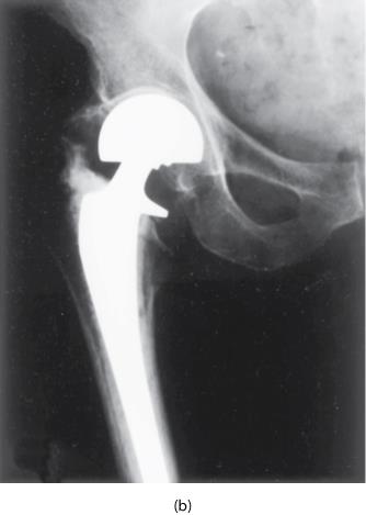 Exemplo Prótese da anca