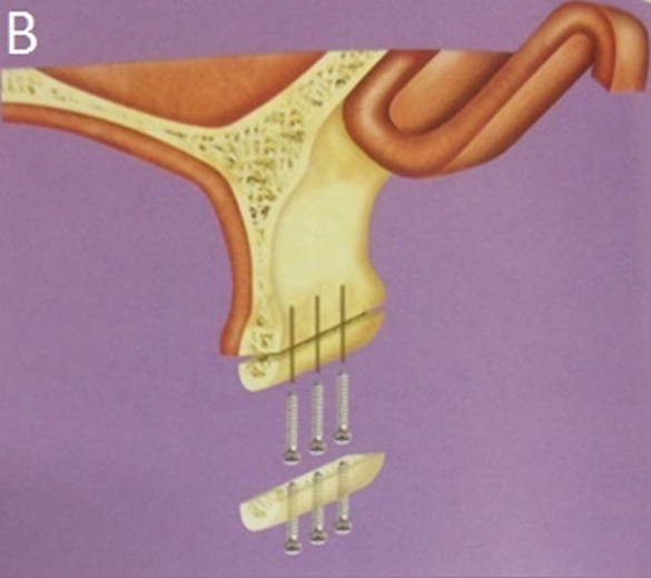 Um enxerto ósseo, por definição, tem por função substituir, aumentar ou reparar tecidos biológicos.