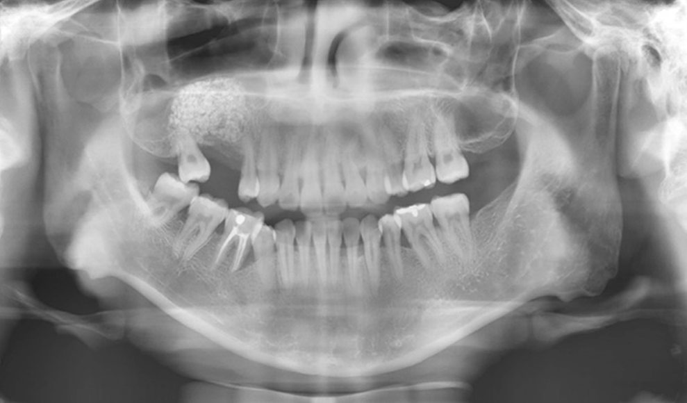 maxilar começa a se insinuar em direção à crista óssea alveolar. A técnica de levantamento do seio maxilar tem se mostrado uma excelente opção na reabilitação da região posterior da maxila.