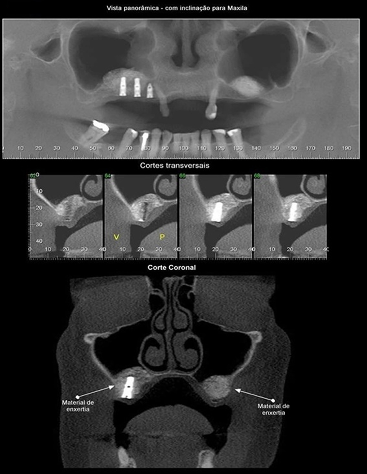 Vista panorâmica, cortes transversais e corte coronal de uma tomografia mostrando imagem de