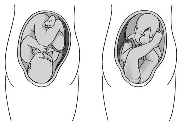 20 LAREDO FILHO, 1987; ROSA FILHO, 2001; BREMM et al., 2002; PIRES; MELO, 2005). A apresentação fetal de nádegas (Fig.