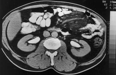 Paniculite mesentérica: aspectos na tomografia computadorizada Figura 3.