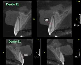 Figura 14. Corte Axial da maxila evidenciando fratura da cortical óssea alveolar vestibular e deslocamento vestibular dos dentes 11 e 21 Figura 12.
