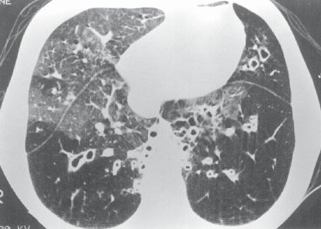 Pereira MC, Pascoal IA, Menezes Nº JR Figura 1 Bronquiectasias graves de localização proximal. Observar áreas de hipoatenuação na região cortical dos dois pulmões, sugestivas de aprisionamento de ar.