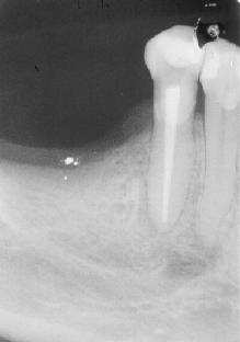 Revista de Endodontia Pesquisa e Ensino On Line - Ano 1, Número 2, Julho/Dezembro, 2005. 5 dentes e uma fístula sobre o rebordo edêntulo na região distal do segundo pré-molar inferior direito.
