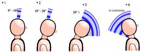 Punhos: avalia-se a postura do punho com a atribuição de pontos de 1 a 3, Figura 3). Sendo que se deve adicionar 1 ponto se o punho apresentar desvio lateral (radial ou ulnar).