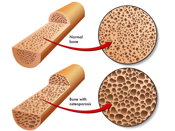 Importância da Integridade Óssea na Osteoartrite A osteoartrite ou artrose (OA) é uma doença que compromete toda a articulação, incluindo cartilagem, ligamentos, sinóvia e osso.