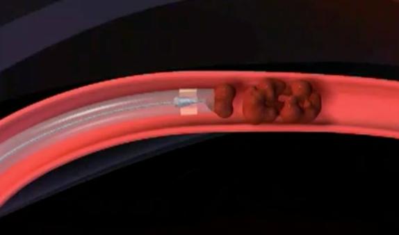 VIA VERDE AVC Trombo na Carótida Interna (intracraniana), remoção por trombectomia TROMBECTOMIA Carótida