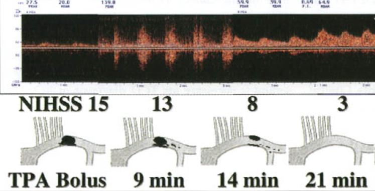 VIA VERDE AVC Terapêutica Adjuvante Sonotrombólise, utilização de ultrassom com