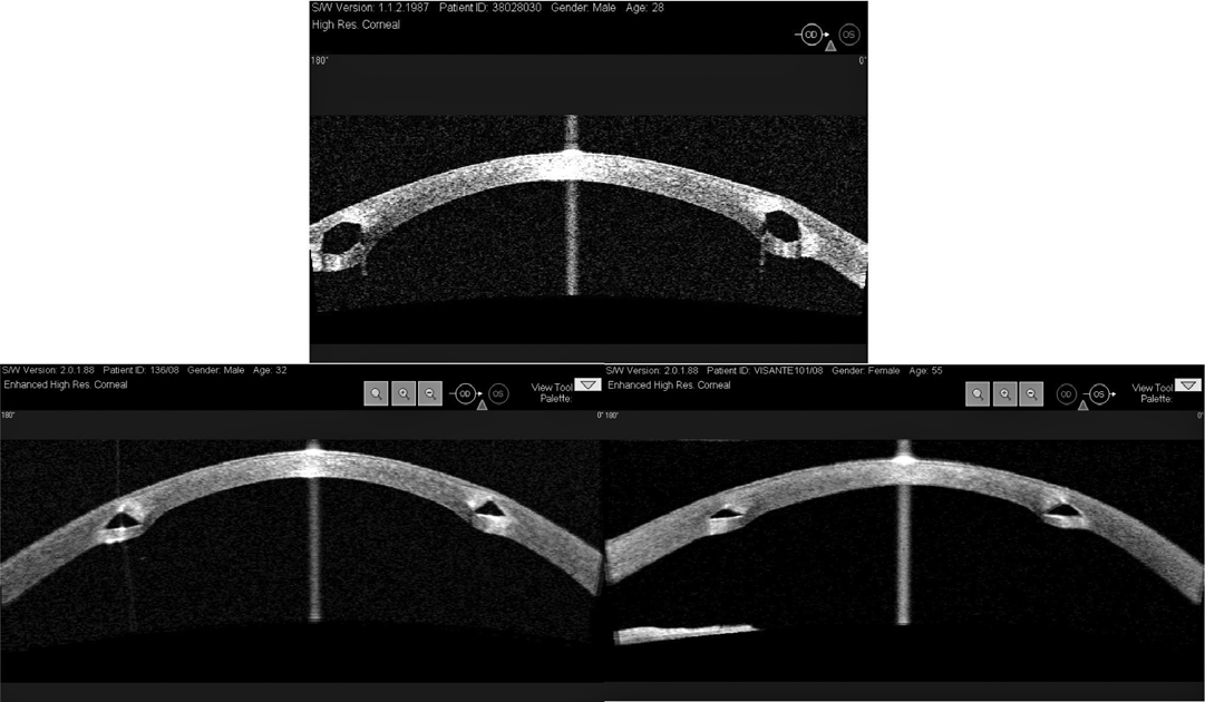 RENESTO AC, SARTORI M, ET AL. A B C Figura 3. A) Imagem do Visante TM OCT-Intacs; B) Imagem do Visante TM OCT-Ferrara; C) Imagem do Visante TM OCT-Keraring.