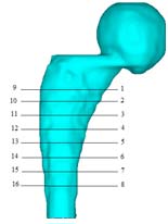 Estudo Comparativo da Influência de Diferentes Materiais em Prótese num Fémur Humano diferentes materiais do implante. São obtidos os resultados das máximas (S) e das mínimas (S) tensões.