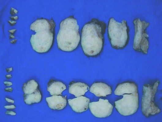 Multidisciplinaridade DESCRIÇÂO DO EXAME ANATOMOPATOLÓGICO EM PROSTATECTOMIAS RADICAIS FIGURA 6 Foto de prostatectomia radical pintada com nanquim de 2 cores (uma para cada lado); FIGURA 7 Próstata