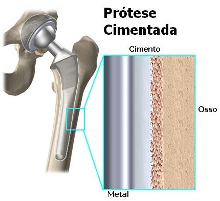 A cirurgia A ARTROPLASTIA TOTAL DO QUADRIL é um procedimento cirúrgico que é indicado para fraturas desviadas do colo do fêmur em idosos e para os casos de artroses dolorosas e incapacitantes do