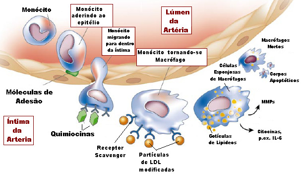Figura 1 Processo de formação das células esponjosas (princípio da aterogênese) FONTE: Adaptado de Libby (2002).