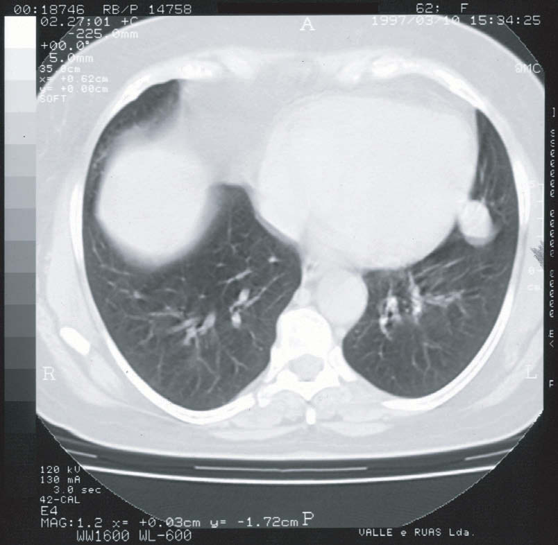 contornos regulares e sem calcificações (Figs. 1 e 2). Foi realizada biópsia transbrônquica, cujo resultado foi inconclusivo, observando-se parênquima pulmonar normal.