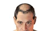 Alopecia no HOMEM (Escala de Norwood) 1) Normal Gr 2) Recuo da linha de implante frontal para minimizar o risco de aumento aplicação e não aplicar imediatamente antes de deitar durante o primeiro mês