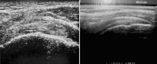 176 A Figura 1 A) Imagem de ultrassom demonstrando alteração anatômica decorrente de área de cicatriz no tendão supraespinal.