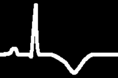 Eletrocardiograma nas SCASSST Valor Prognóstico Independente
