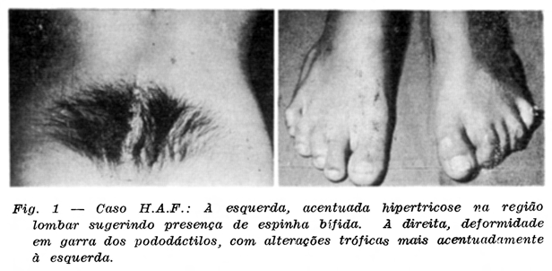hipertricose na região lombar e deformidade em garra dos artelhos do pé esquerdo, com alterações tróficas (Fig. 1). RX simples de coluna lombossacra evidenciou espinha bífida (L4-L5).