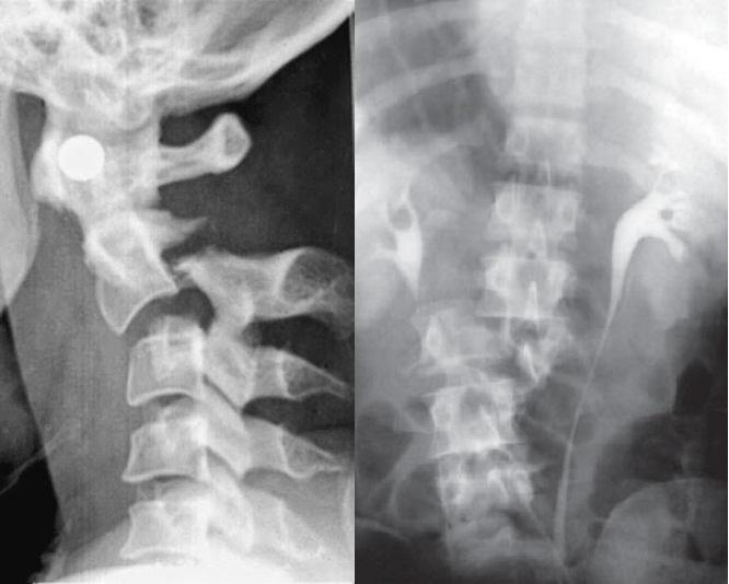 Fig. 6 Fratura de cervical na imagem à esquerda e fratura de coluna lombar na imagem à direita Fonte: http://jhhamannmundodaradiologia.blogspot.com.br/2014/12/coluna-vertebral-parteiv_8.