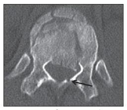 Fig. 7 Estreitamento do canal medular por trauma de coluna Fonte: http://www.rb.org.br/imagebank/imagens/v45n2a08-fig04.jpg Fig.