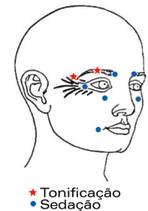 13 Rugas paranasais Tonificação Sedação Figura 9: as rugas surgem ao lado do nariz, geralmente oblíquas de cima para baixo e de dentro para fora.