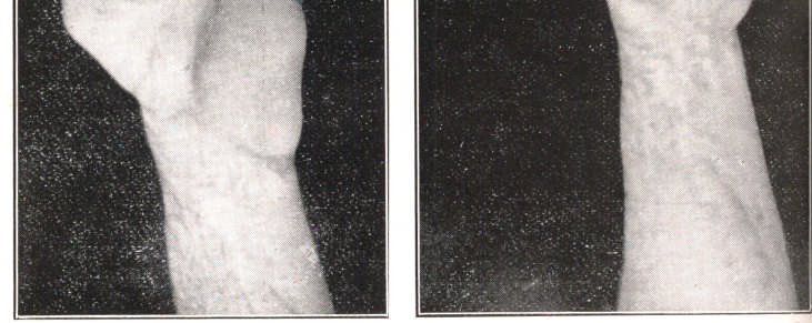 208 Resultado de um enxêrto pediculado empregado para corrigir grave retração cicatrical palmar devida a acidente com amassadeira. Este caso foi operado há cinco anos pelo Prof. Antônio Prudente.