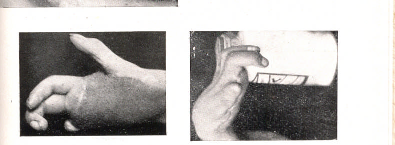 209 Graves seqüela devida a acidente em amassadeira. Um enxêrto tubular foi confeccioado na parede abdominal afim de ser transplantado para a mão inválida. Na fig.