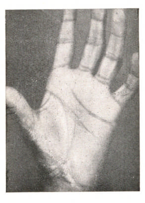 194 Cicatriz retrátil resultante de profunda ferida contusa da região tonar. O polegar estava fixado em adução e a mão em ligeira flexão.