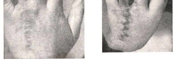 195 Forte retratação cicatrical conseqüente a uma tentativa fracassada de correção cirúrgica de uma sindactilia congênita.