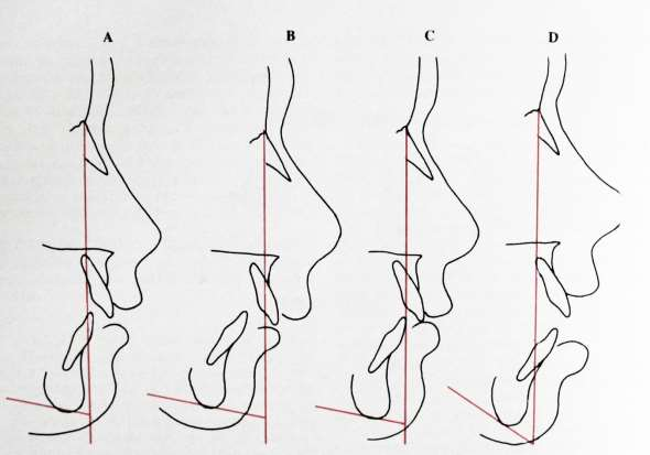 16 Figura 1 - Combinações de estruturas esqueléticas que podem levar a uma maloclusão de Classe II: A, protrusão da maxila com uma mandíbula normal; B, retrusão mandibular com uma maxila normal; C, a