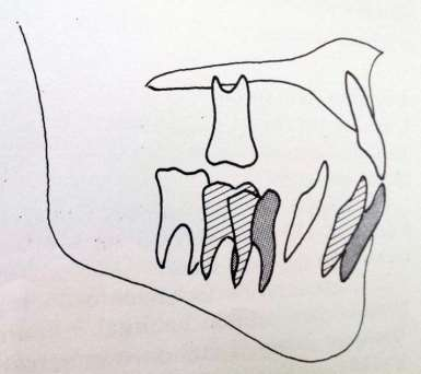 29 Figura 9 - Posicionamento anterior da mandíbula em duas fases. 1ª fase: linhas; 2ª fase: pontilhados. Fonte: GRABER; NEUMANN, 1987, 204p.