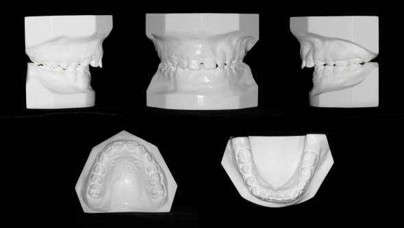 46 Discrepâncias de modelo e tamanho dentário. Figura 15 - Modelos de gesso de paciente com maloclusão esquelética de Classe II, 1ª divisão. Fonte: elaborado pelo autor.