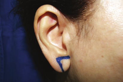 Rejuvenescimento de lóbulo de orelha simulando alargamento do furo ou lóbulo bífido incompleto (Figura 1).