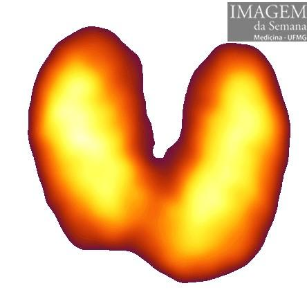 Imagem da Semana: Cintilografia Figura 1: Cintilografia da tireoide (123Iodo) Enunciado Paciente do sexo feminino, 23 anos, previamente hígida, com queixa de tremor, sudorese, palpitação, queda de