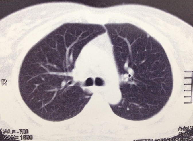 FIGURA 3 Lesão osteolítica em fêmur esquerdo proximal em TC de bacia células estas que secretam imunoglobulina monoclonal Fonte Fotografia denominada exame obtida proteína em nosso serviço M.