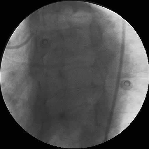 Cateterismo Cardíaco Coronariografia Caso 1 45 anos HTA, Dislipidemia,