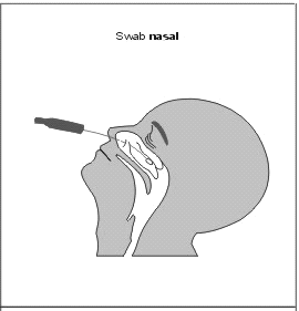 b) Swab nasal e orofaringe (3 swabs) Examinar a fossa nasal do paciente com o intuito de verificar a presença de secreções e a posição do corneto inferior e médio.