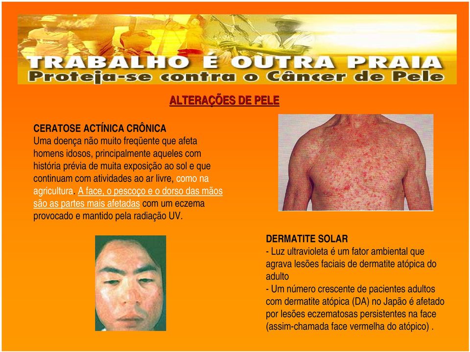 A face, o pescoço e o dorso das mãos são as partes mais afetadas com um eczema provocado e mantido pela radiação UV.