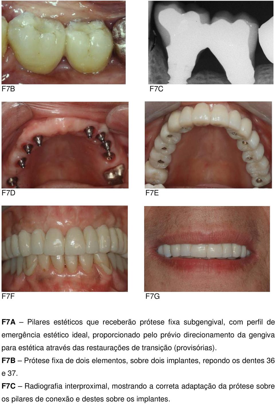 transição (provisórias). F7B Prótese fixa de dois elementos, sobre dois implantes, repondo os dentes 36 e 37.
