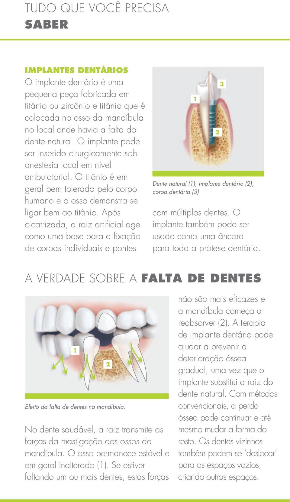Após cicatrizada, a raiz artificial age como uma base para a fixação de coroas individuais e pontes 1 Dente natural (1), implante dentário (2), coroa dentária (3) com múltiplos dentes.