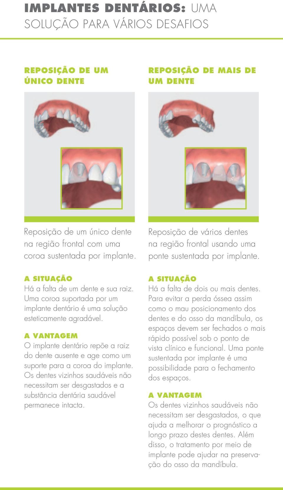 Uma coroa suportada por um implante dentário é uma solução esteticamente agradável. A VANTAGEM O implante dentário repõe a raiz do dente ausente e age como um suporte para a coroa do implante.