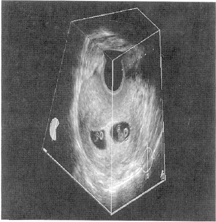 Scan rotacional Three-dimensional image of a pregnant uterus with twins. The image has been "sliced to reveal the two gestational sacs.