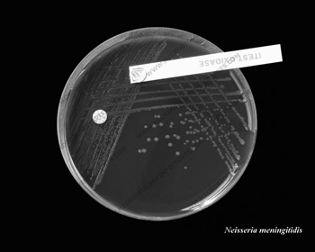 Coleta LCR CUIDADOS NA COLETA DO LÍQUOR Anti-sepsia da pele: Álcool a 70% ou iodóforo (aguardar 1 min.